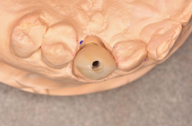 Protetické ošetření chybějícího horního špičáku U implantátu s bukálním sklonem